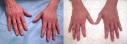 Stem cell skin regeneration on the hands